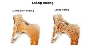 Bệnh loãng xương là gì? Dấu hiệu nhận biết nhanh về bệnh loãng xương