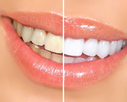 Không cần tốn tiền vẫn có thể làm trắng răng tại nhà bạn đã thử?