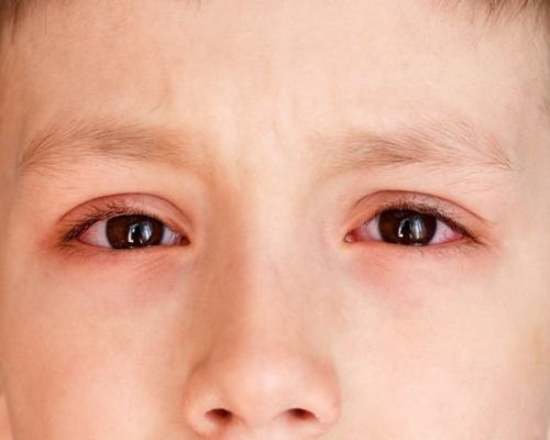 dấu hiệu của trẻ bị đau mắt đỏ